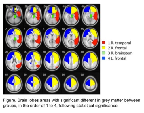 Sahaja Yoga meditation brain lobes study